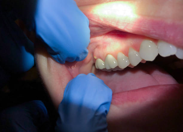 Best Emergency Dentist for Knocked-Out Tooth in Winter Springs, FL
